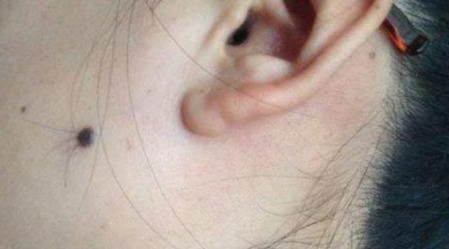 你有癌前病变吗?对照10种情况,一定要提高警惕